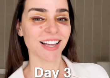 Vanessa Martins fez nova cirurgia estética e está a ser criticada